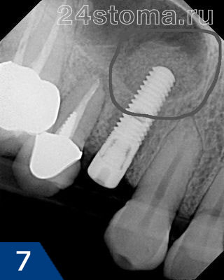 Снимок после операции: вокруг верхушки импланта вы можете увидеть рентгеноконтрасную костную ткань, выведенную в процессе синус-лифтинга