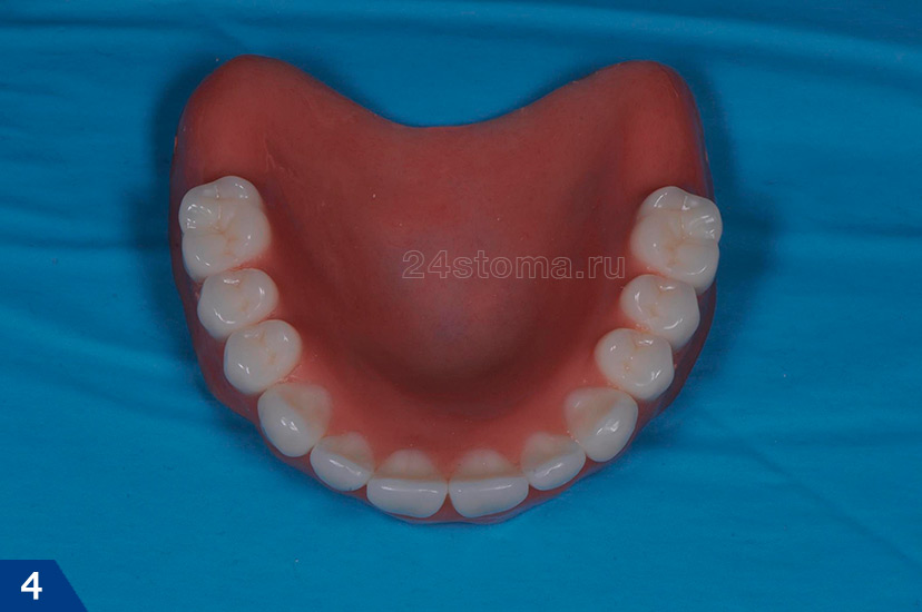 Съемный зубной протез из обычной акриловой пластмассы