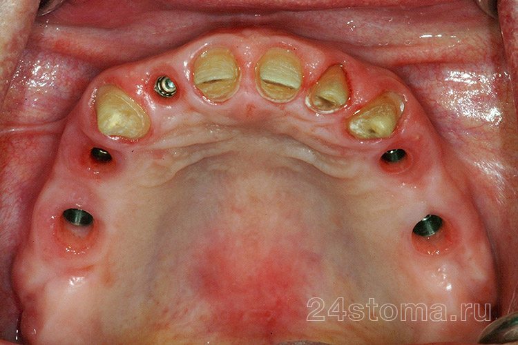 В верхнюю челюсть установлено 5 имплантов (остальные зубы обточены под коронки)