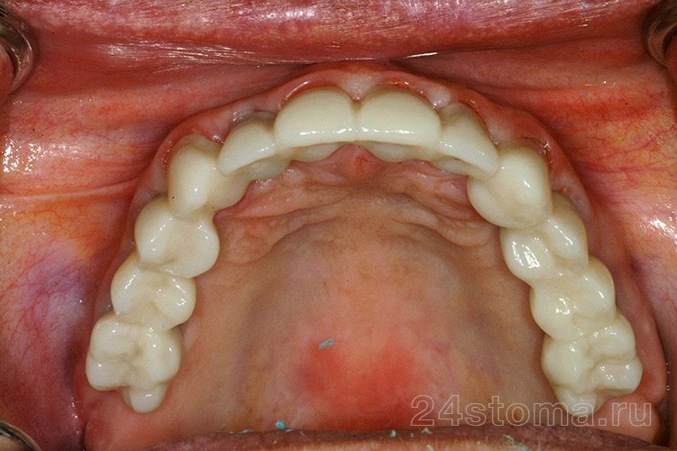 На абатменты, а также на обточенные под коронки собственные зубы пациента - установлены металлокерамические коронки (цементный тип фиксации)