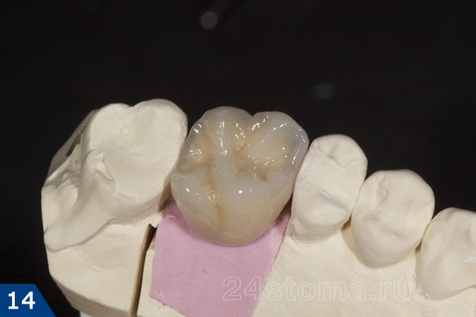 Металлокерамическая коронка с титановым абатментом в собранном фиде на гипсовой модели зубов пациента