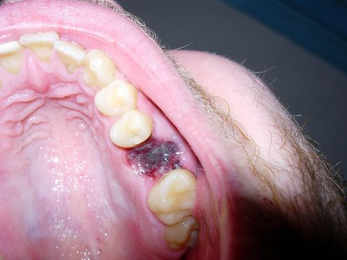 Сколько времени заживает зуб после лечения thumbnail