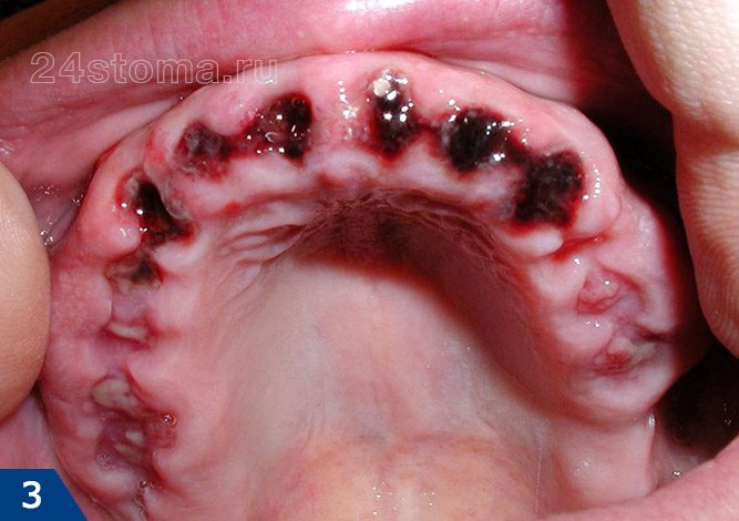 Вид лунок удаленных шести передних зубов на следующий день после удаления