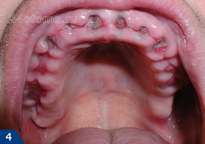 Вид лунок удаленных шести передних зубов через 7 дней после удаления