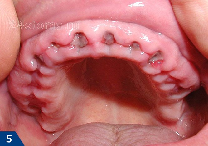 Вид лунок удаленных шести передних зубов через 12 дней после удаления