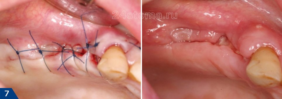 Наложение глухих швов после удаления 2-х зубов. Вид лунок удаленных зубов всего через 10 дней.