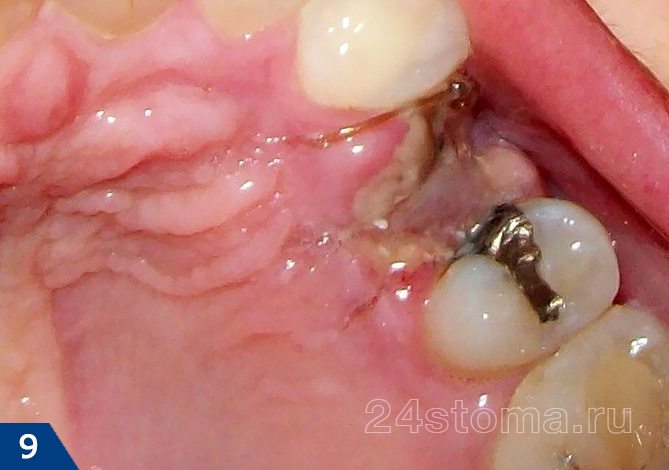 Вид лунки через 4-5 дней после удаления зуба (поверхность сгустка и травмированная краевая десна покрыты белым фибринозным налетом)