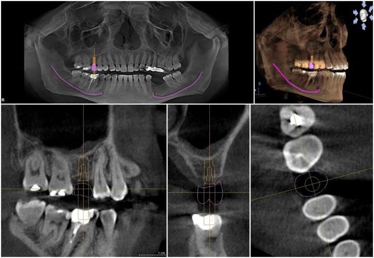 Компьютерная томография зубов (снимок открыт в специальной программе на персональном компьютере)