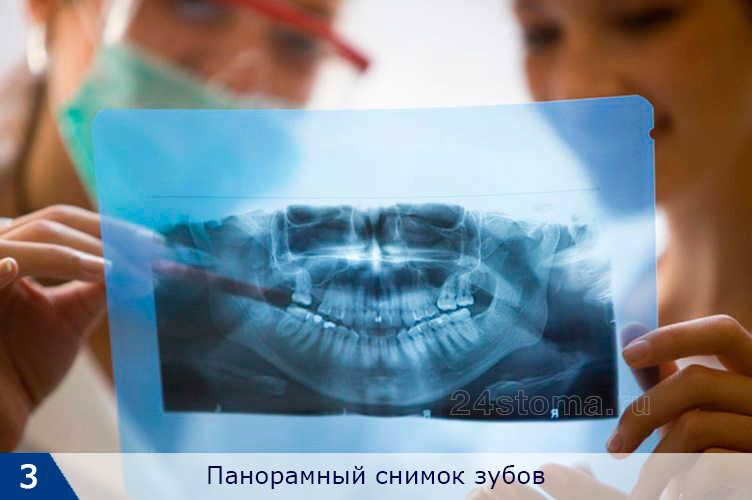 Готовая ортопантомограмма, распечатанная на пленке
