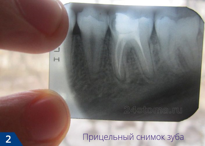 Готовый прицельный снимок зуба на пленке