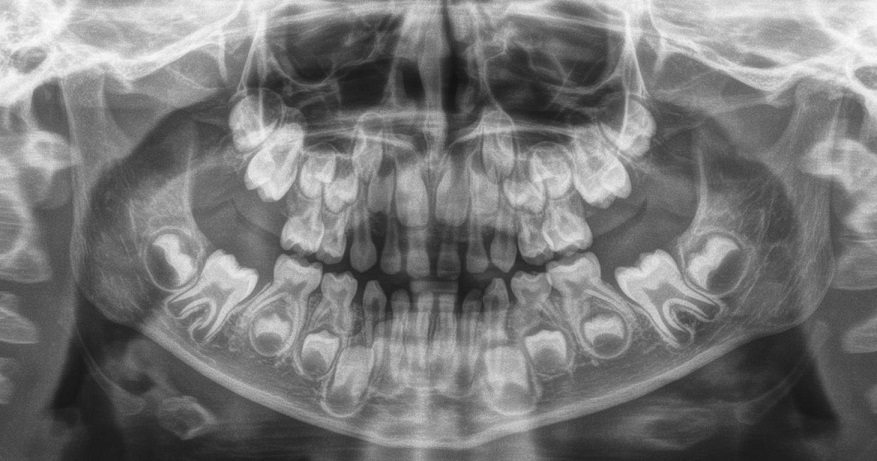 На панорамном снимке ребенка можно увидеть, что под корнями молочных зубов расположены зачатки постоянных зубов. Кроме того постоянные нижние резцы уже прорезались, а постоянные 6-ые зубы находятся в состянии прорезывания