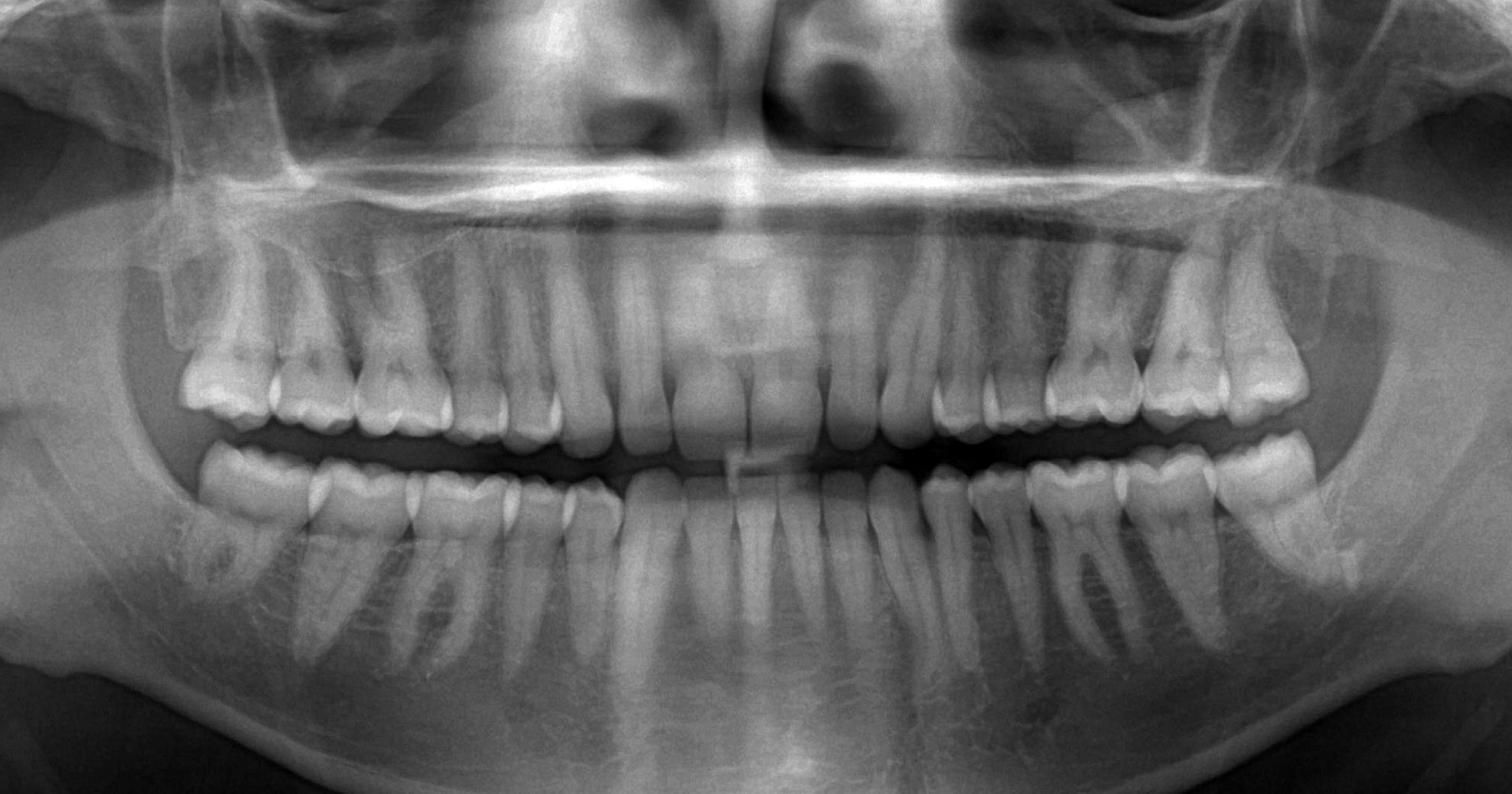 32 постоянных коренных зуба взрослого человека на панорамном рентгеновском снимке