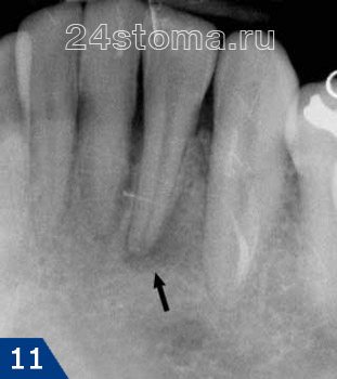 Наличие у верхушки корня зуба затемнения нечеткой формы говорит о развитии хронического гранулирующего периодонтита