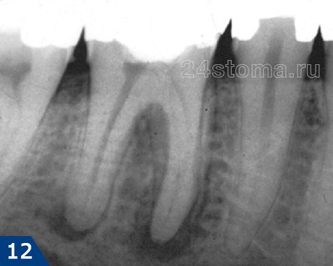 Наличие у обоих верхушек корней зуба затемнений четкой формы говорит о развитии хронического гранулематозного периодонтита (гранулемы)