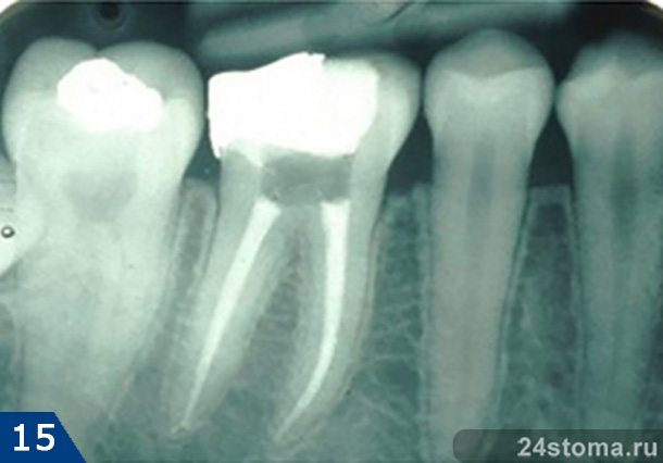 На снимке показаны качественно запломбированные корневые каналы 6-го зуба (оба канала запломбированы до верхушки корня, причем обтурация каналов пломбировочным веществом плотная, без пустот)