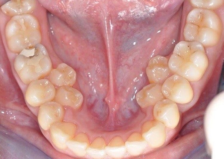 Сверхкомплектные малые коренные зубы (премоляры) на нижней челюсти