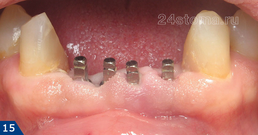 Установлены 4 мини-импланта (из расчета 1 мини-имплант на 1 отсутствующий зуб)