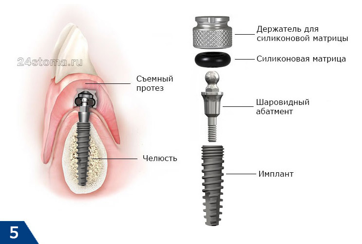 Схема фиксации съемного зубного протеза на имплантах (при надевании протеза шаровидный аттачмент, проникая сквозь кольцевой аттачмент, удерживается последним)