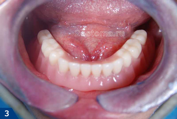 Вид условно-съемного протеза на имплантах в полости рта