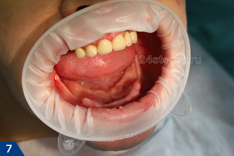 Исходная ситуация - полное отсутствие зубов на нижней челюсти (высокая атрофия кости в боковых отделах нижней челюсти)