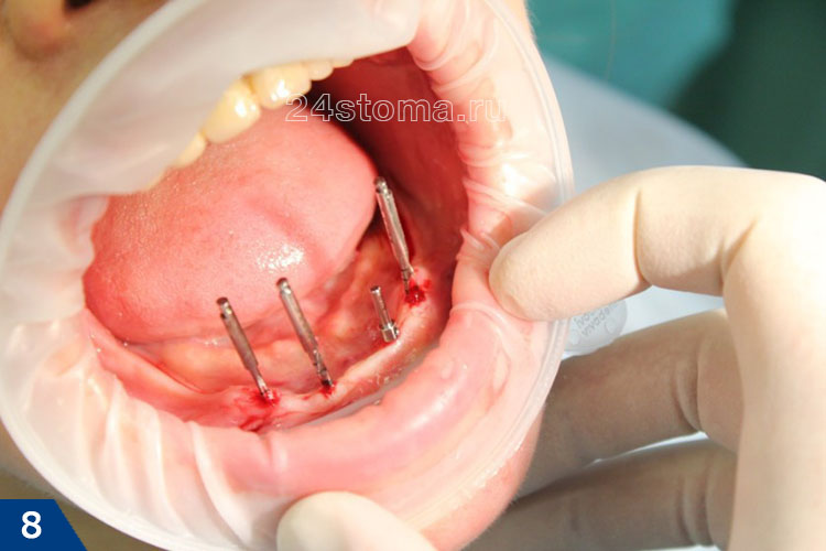 Процесс хирургической установки 4-х мини-имплантов