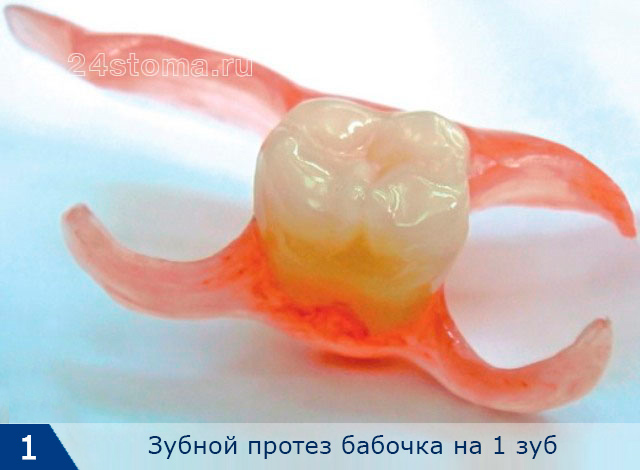 Зубной мини-протез бабочка на 1 зуб
