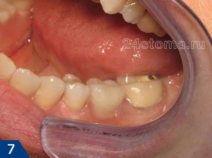 Нейлоновый микропротез на 1 зуб: до и после