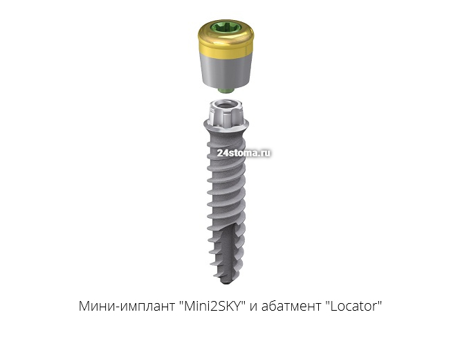 Мини-имплант «Mini2SKY» диаметр 2.8 мм (в комплекте со съемным экваторным абатментом Locator)