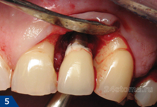 После ослойки десны видна потеря кости вокруг импланта, а также большое количество микробного зубного налета в области шейки импланта)
