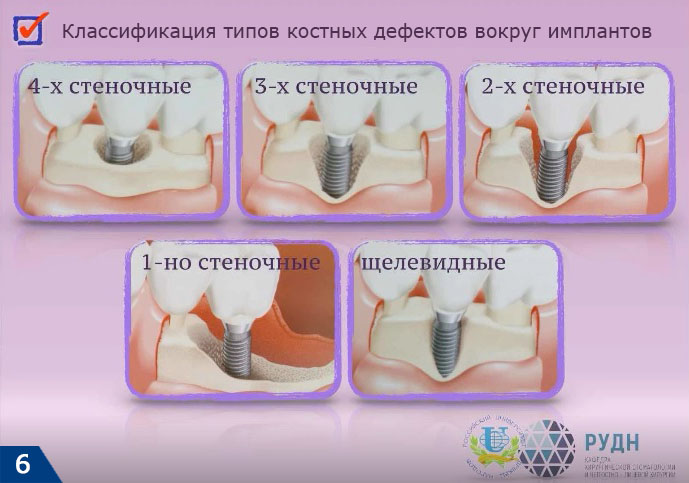 Типы костных дефектов вокруг одиночного импланта