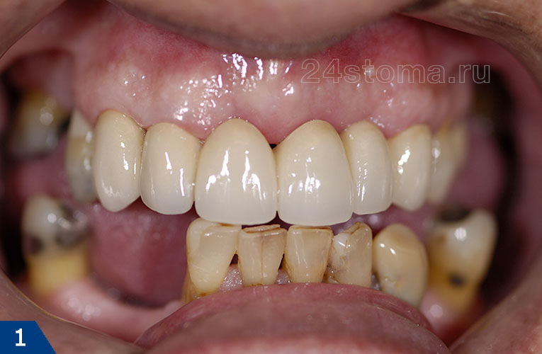 Металлокерамические коронки на шести верхних передних зубах