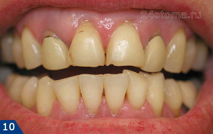Исходная ситуация - планируется изготовление металлокерамических коронок на 4 передних верхних зуба