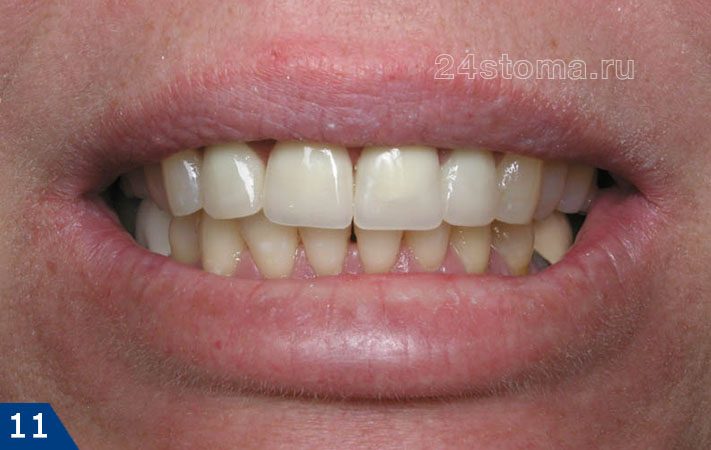 Готовая работа - металлокерамические коронки фиксированы на 4 передних верхних зубах