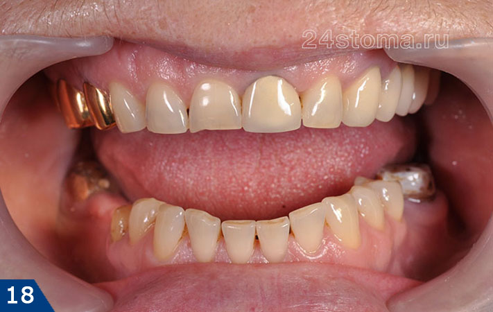 Исходная ситуация - планируется изготовление циркониевых коронок на все верхние зубы, а также на нижние зубы - в боковых отделах зубного ряда