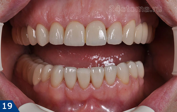 Циркониевые коронки изготовлены на все зубы верхней челюсти и часть зубов нижней челюсти