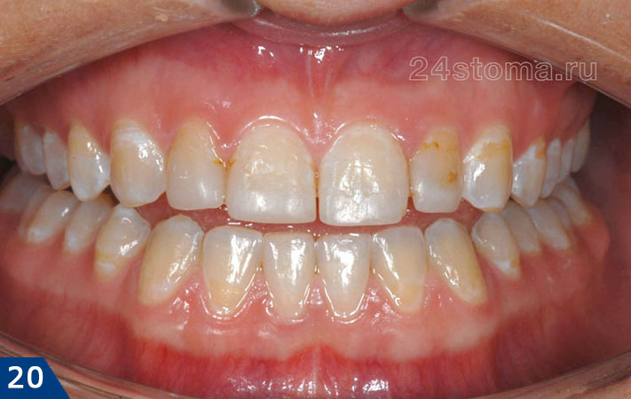 Исходное состояние зубов