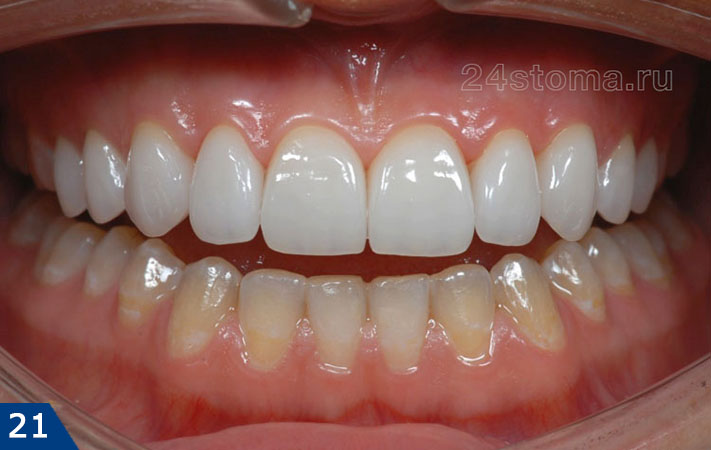 Вид готовой работы - на верхних зубах фиксировано 10 коронок из Emax CAD