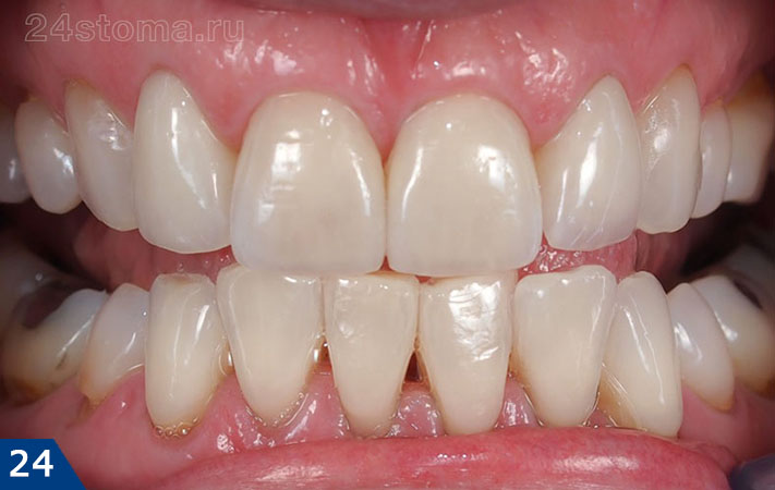 Готовая работа - виниры из E-max PRESS на четырех передних верхних зубах