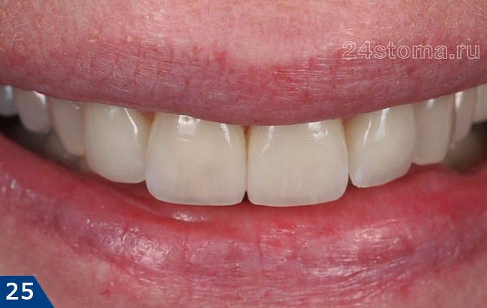 Готовая работа - виниры из E-max PRESS на четырех передних верхних зубах