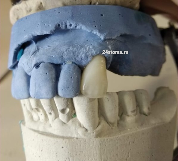 Пластмассовая коронка, изготовленная непрямым методом (в кювете). Работа выполнена в зуботехнической лаборатории "Ортос".
