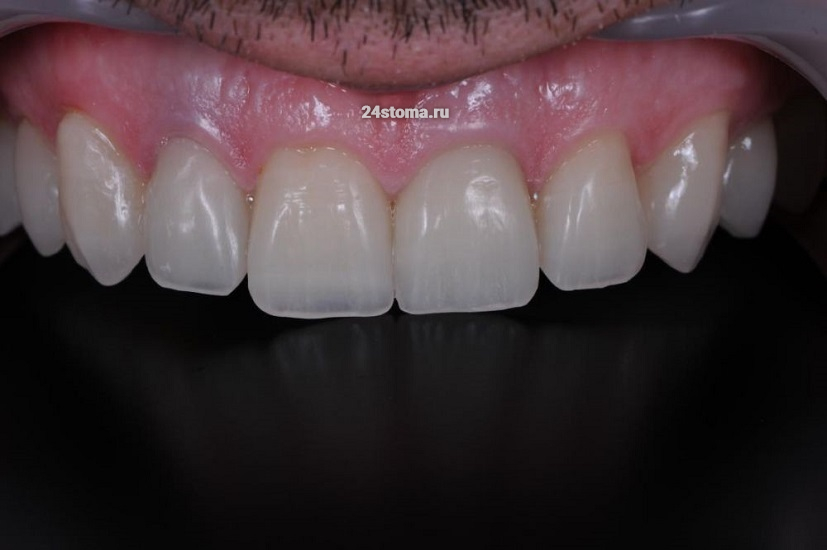 Вид зубов после фиксации 12 одиночных коронок из PMMA Multi-layer