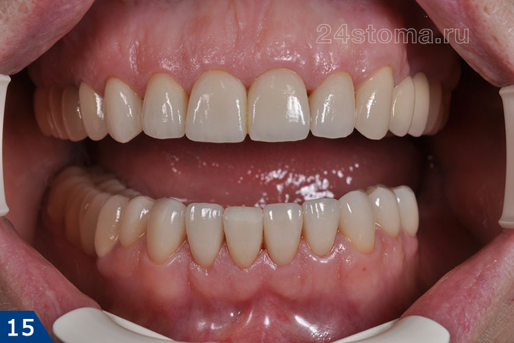 Циркониевые коронки изготовлены на все передние зубы верхней и нижней челюстей