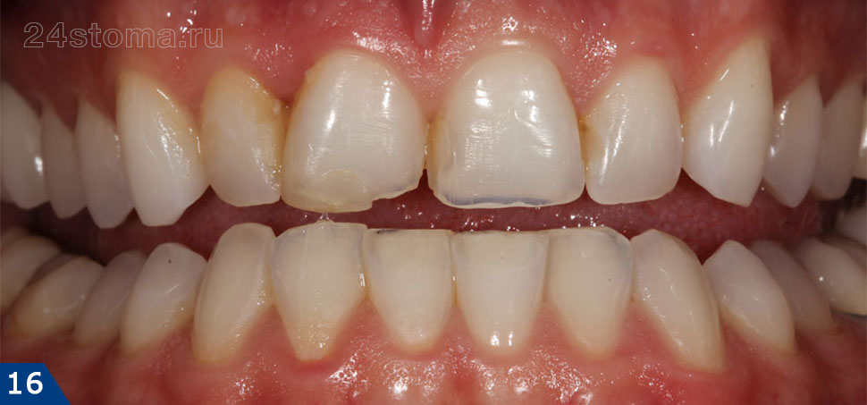 Коронки E-max на 4-х передних верхних зубах (фото до и после)