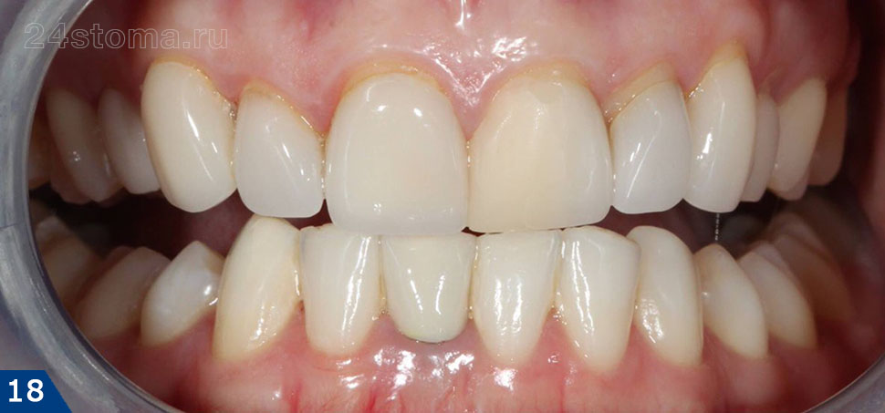 Исходная ситуация - планируется изготовление виниров Emax на 6 верхних передних зубов