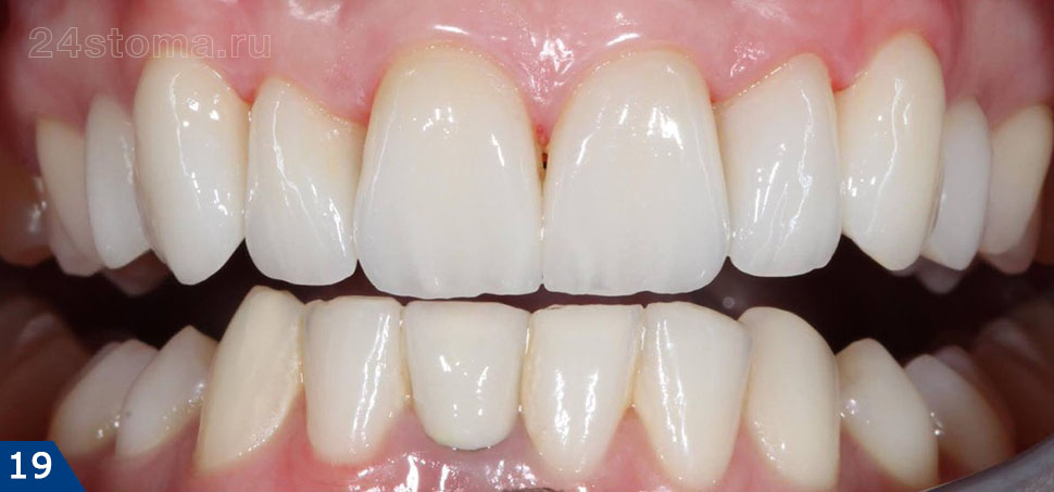 Изготовленеые виниры Emax на 6 верхних передних зубов
