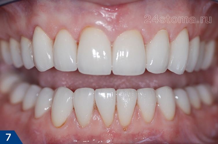 Вид готовой работы - керамические коронки Emax на всех верхних и нижних зубах