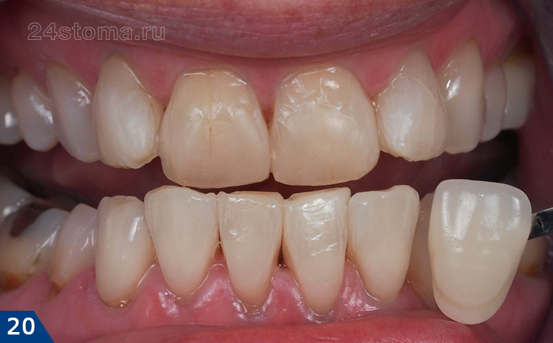Исходная ситуация - планируются виниры из E-max PRESS на четыре передних верхних зуба