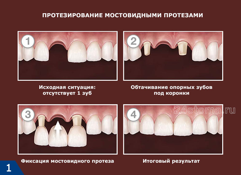 Схема протезирования мостовидным протезом при одиночно отсутствующем зубе