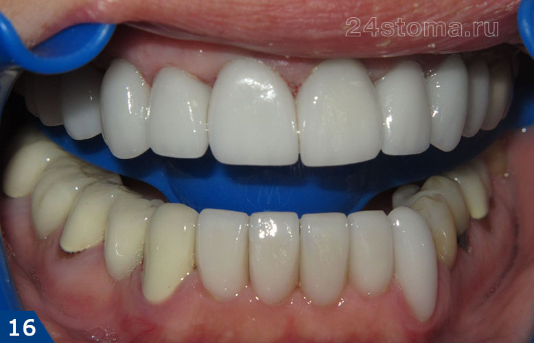 Протезирование мостовидным протезом и одиночными коронками из диоксида циркония (все зубы верхней челюсти + 5 передних зубов нижней челюсти)