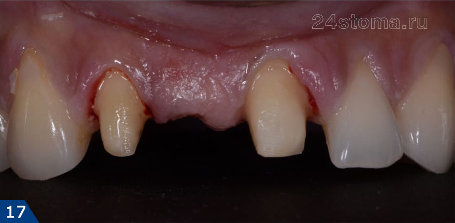 Исходная ситуация - отсутствует центральный резец (соседние зубы обточены под коронки)